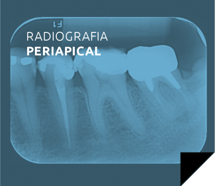 radiografia_periapical
